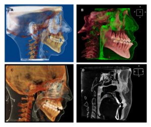 Volume-rendered-CBCT-images-for-the-airway-in-either-color-enhanced